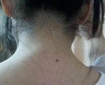 為什么很多人的脖子后面都有一顆黑痣,看看你有沒有中 為什么很多人的脖子后面都有一顆黑痣,看看你有沒有中