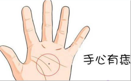 掌心痣是福是禍,看完這三點,再決定要不要點痣 掌心痣是福是禍,看完這三點,再決定要不要點痣