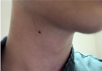 男人的福痣和禍痣 男人的福痣和禍痣