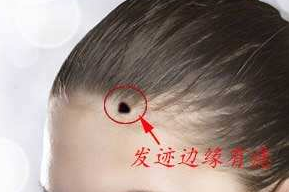 頭發(fā)邊緣有痣代表什么,發(fā)際線上有痣命運如何 頭發(fā)邊緣有痣代表什么,發(fā)際線上有痣命運如何